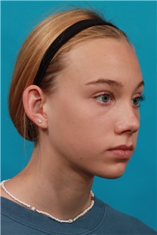 Ear Surgery Before Photo by Michael Bogdan, MD, MBA, FACS; Grapevine, TX - Case 44362