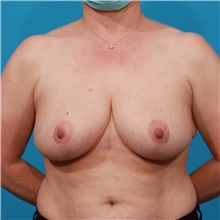 Breast Reduction After Photo by Michael Bogdan, MD, MBA, FACS; Grapevine, TX - Case 44366