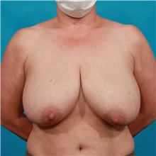 Breast Reduction Before Photo by Michael Bogdan, MD, MBA, FACS; Grapevine, TX - Case 44366