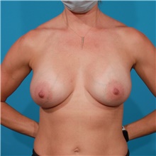 Breast Augmentation After Photo by Michael Bogdan, MD, MBA, FACS; Grapevine, TX - Case 44370