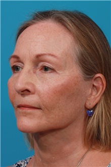 Facelift After Photo by Michael Bogdan, MD, MBA, FACS; Grapevine, TX - Case 44371