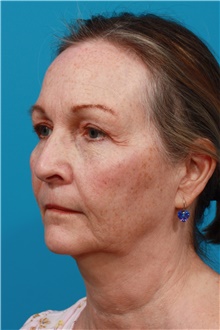 Facelift Before Photo by Michael Bogdan, MD, MBA, FACS; Grapevine, TX - Case 44371