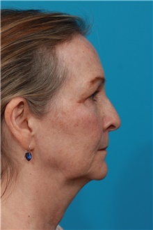 Facelift Before Photo by Michael Bogdan, MD, MBA, FACS; Grapevine, TX - Case 44371