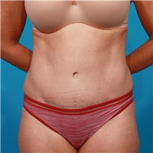 Tummy Tuck After Photo by Michael Bogdan, MD, MBA, FACS; Grapevine, TX - Case 44372