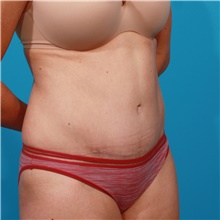 Tummy Tuck After Photo by Michael Bogdan, MD, MBA, FACS; Grapevine, TX - Case 44372