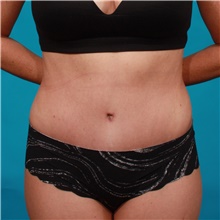 Tummy Tuck After Photo by Michael Bogdan, MD, MBA, FACS; Grapevine, TX - Case 44375