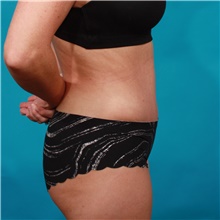 Tummy Tuck After Photo by Michael Bogdan, MD, MBA, FACS; Grapevine, TX - Case 44375