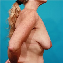 Breast Augmentation Before Photo by Michael Bogdan, MD, MBA, FACS; Grapevine, TX - Case 44377
