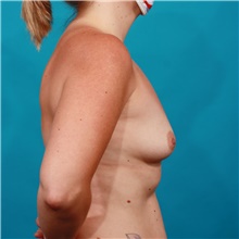 Breast Augmentation Before Photo by Michael Bogdan, MD, MBA, FACS; Grapevine, TX - Case 44434