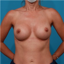 Breast Augmentation After Photo by Michael Bogdan, MD, MBA, FACS; Grapevine, TX - Case 44436