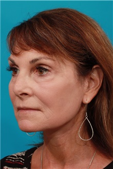 Facelift After Photo by Michael Bogdan, MD, MBA, FACS; Grapevine, TX - Case 44438