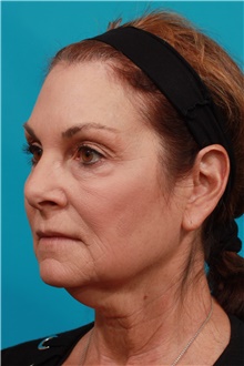 Facelift Before Photo by Michael Bogdan, MD, MBA, FACS; Grapevine, TX - Case 44438