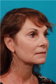 Facelift After Photo by Michael Bogdan, MD, MBA, FACS; Grapevine, TX - Case 44438