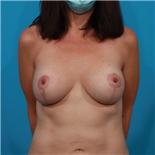 Breast Lift After Photo by Michael Bogdan, MD, MBA, FACS; Grapevine, TX - Case 44440