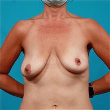 Breast Lift Before Photo by Michael Bogdan, MD, MBA, FACS; Grapevine, TX - Case 44440
