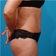 Tummy Tuck After Photo by Michael Bogdan, MD, MBA, FACS; Grapevine, TX - Case 44444