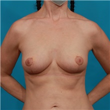 Breast Lift After Photo by Michael Bogdan, MD, MBA, FACS; Grapevine, TX - Case 44445