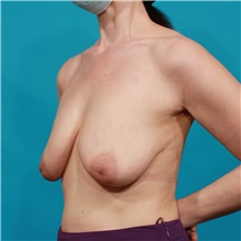 Breast Lift Before Photo by Michael Bogdan, MD, MBA, FACS; Grapevine, TX - Case 44445