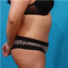 Tummy Tuck After Photo by Michael Bogdan, MD, MBA, FACS; Grapevine, TX - Case 44448