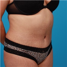 Tummy Tuck After Photo by Michael Bogdan, MD, MBA, FACS; Grapevine, TX - Case 44448