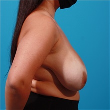 Breast Reduction Before Photo by Michael Bogdan, MD, MBA, FACS; Grapevine, TX - Case 44455