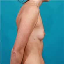 Breast Augmentation Before Photo by Michael Bogdan, MD, MBA, FACS; Grapevine, TX - Case 44456