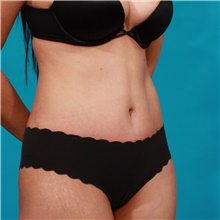 Tummy Tuck After Photo by Michael Bogdan, MD, MBA, FACS; Grapevine, TX - Case 44457