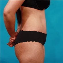 Tummy Tuck After Photo by Michael Bogdan, MD, MBA, FACS; Grapevine, TX - Case 44457
