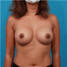 Breast Augmentation After Photo by Michael Bogdan, MD, MBA, FACS; Grapevine, TX - Case 44464