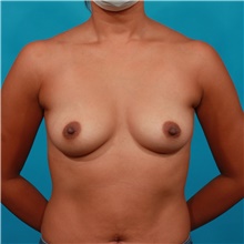 Breast Augmentation Before Photo by Michael Bogdan, MD, MBA, FACS; Grapevine, TX - Case 44464