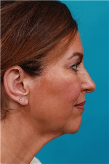 Facelift Before Photo by Michael Bogdan, MD, MBA, FACS; Grapevine, TX - Case 44465