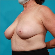 Breast Lift Before Photo by Michael Bogdan, MD, MBA, FACS; Grapevine, TX - Case 45763