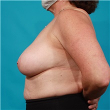 Breast Lift Before Photo by Michael Bogdan, MD, MBA, FACS; Grapevine, TX - Case 45763