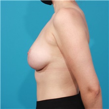 Breast Lift After Photo by Michael Bogdan, MD, MBA, FACS; Grapevine, TX - Case 45765