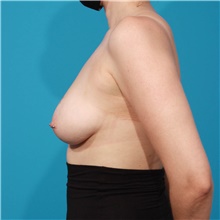 Breast Lift Before Photo by Michael Bogdan, MD, MBA, FACS; Grapevine, TX - Case 45765