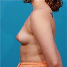 Breast Augmentation Before Photo by Michael Bogdan, MD, MBA, FACS; Grapevine, TX - Case 45769