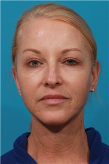 Facelift After Photo by Michael Bogdan, MD, MBA, FACS; Grapevine, TX - Case 45770