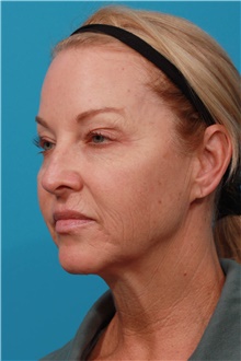 Facelift Before Photo by Michael Bogdan, MD, MBA, FACS; Grapevine, TX - Case 45770