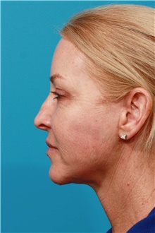 Facelift After Photo by Michael Bogdan, MD, MBA, FACS; Grapevine, TX - Case 45770