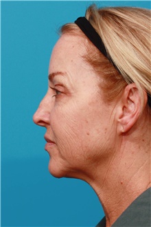Facelift Before Photo by Michael Bogdan, MD, MBA, FACS; Grapevine, TX - Case 45770
