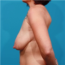 Breast Lift Before Photo by Michael Bogdan, MD, MBA, FACS; Grapevine, TX - Case 45771
