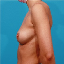 Breast Augmentation Before Photo by Michael Bogdan, MD, MBA, FACS; Grapevine, TX - Case 45776