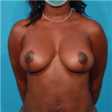 Breast Lift After Photo by Michael Bogdan, MD, MBA, FACS; Grapevine, TX - Case 45781