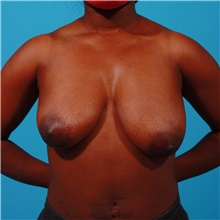 Breast Lift Before Photo by Michael Bogdan, MD, MBA, FACS; Grapevine, TX - Case 45781
