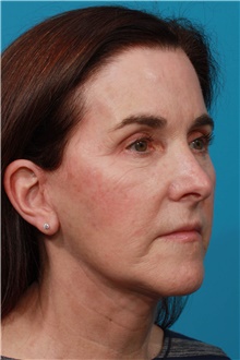 Facelift After Photo by Michael Bogdan, MD, MBA, FACS; Grapevine, TX - Case 45783