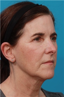 Facelift Before Photo by Michael Bogdan, MD, MBA, FACS; Grapevine, TX - Case 45783