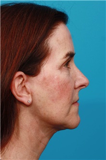 Facelift After Photo by Michael Bogdan, MD, MBA, FACS; Grapevine, TX - Case 45783