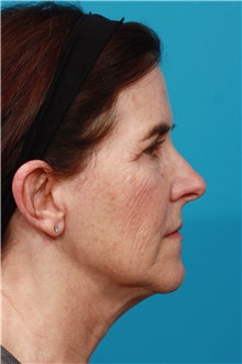 Facelift Before Photo by Michael Bogdan, MD, MBA, FACS; Grapevine, TX - Case 45783