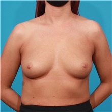 Breast Augmentation Before Photo by Michael Bogdan, MD, MBA, FACS; Grapevine, TX - Case 45784