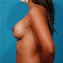 Breast Augmentation After Photo by Michael Bogdan, MD, MBA, FACS; Grapevine, TX - Case 45787